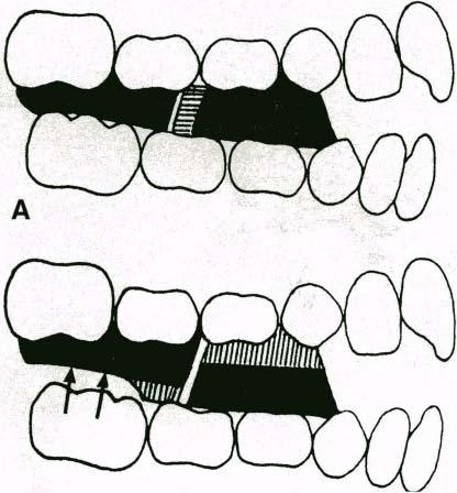 18 Mills and McCulloch American Journal of Orthodontics and Dentofacial Orthopedics., July 1998 124 33 B Fig. 3A.