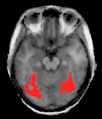 ilateral superior temporal gyrus, (c) secondary somatosensory cortex (S2), (d) ilateral TPJ.