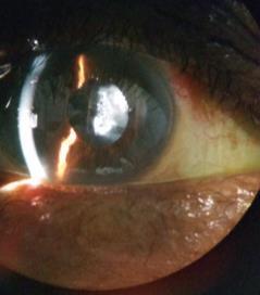 TASS Endophthalmitis Cause Non-infectious response Bacterial, viral, fungal Onset 12-24 Hours** 2-7 Days Signs/Symptoms Blurry VA Pain: none to moderate Severe corneal edema Irregular/unresponsive