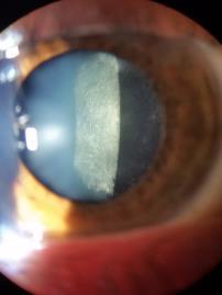 Approach like traditional uveitis: aggressive steroid dosing with slow taper Chronic corneal edema Corneal decompensation Treatment: Non-CAI IOP lowering drops Bandage