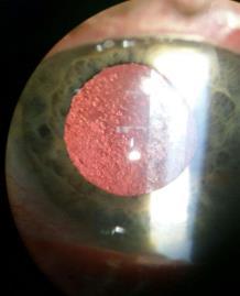 lens capsule Glare complaints and/or reduced acuities Nd:YAG laser capsulotomy Diabetic retinopathy and CSME 20-40% more likely to experience worsening NPDR and PDR