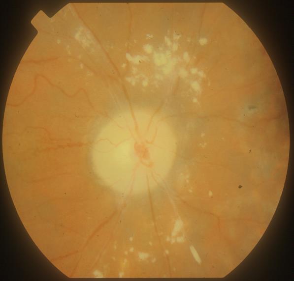 will limit visual outcome macular