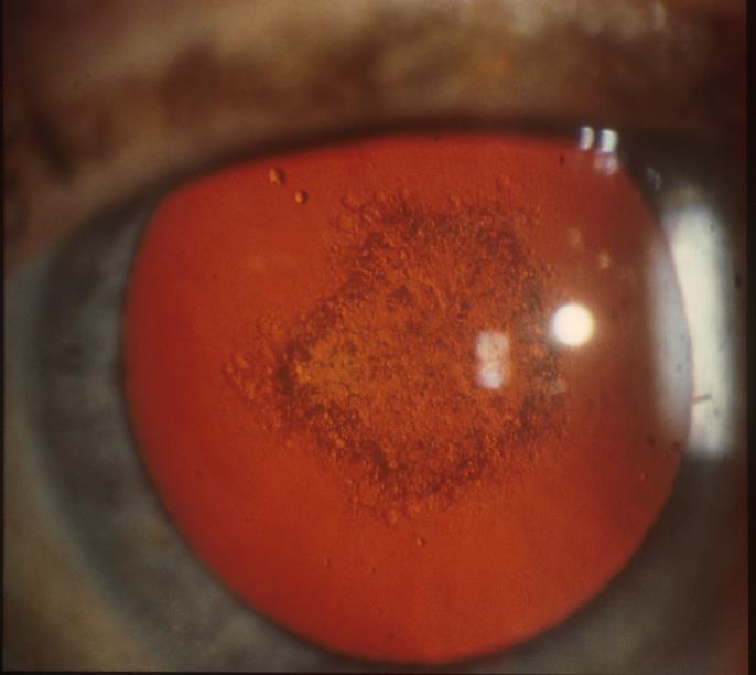 Causes of Vision Loss in Uveitis 1. Cystoid macular oedema 26% 2. Cataract 19% 3.