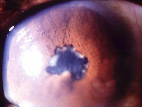 58yr Female 12mth history of: Bilateral granulomatous panuveitis Secondary CME Managed