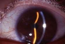 Clinical examination: Cornea: Endothelial count and pachymetry where possible. Band keratopathy.