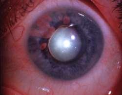 Anticipate post-op pressure problems Expect a floppy iris, likely to bleed