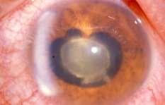 Atrophic Iris with IPE dropout PRE-OPERATIVE CONSIDERATIONS Clinical