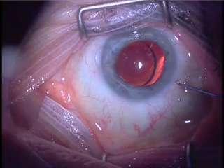 Considerations in the Cataract Patient with Glaucoma Robert