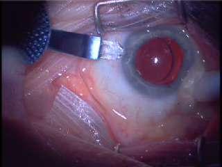 ECP can be done through cataract