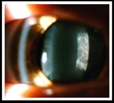 induce myopia Cortical Cataract Often