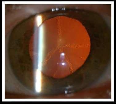 distortion/glare Subcapsular Cataract May