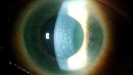 Auckland Cataract Study 2: Postoperative complications Postoperative complications 8.