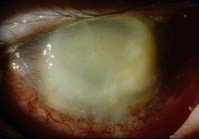 6% Incidence of cataract surgery increased x3 However, endophthalmitis rate constant at 2 per 1000 Semmens JB, Li J,