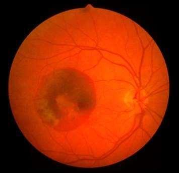 macula Exclude retinal