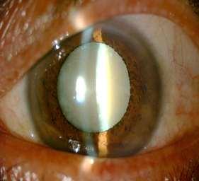 Aetiology of cataract