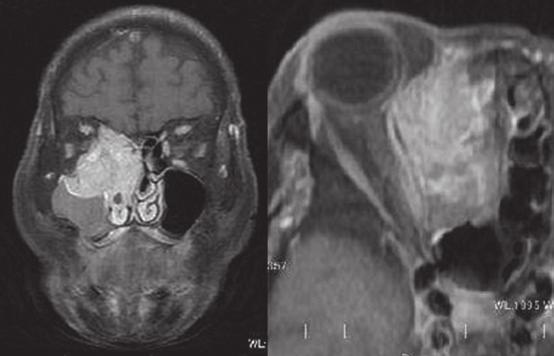 1756 ISHIDA and OKABE: CATHEPSIN K IN BASALOID SCC Figure 1. MRI showing a right sided maxillary sinus tumor invading into the dura mater and orbit. MRI, magnetic resonance imaging.