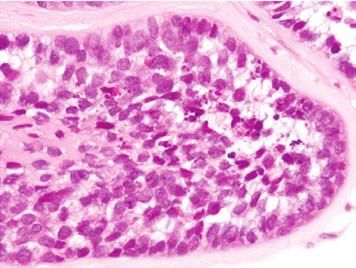 Histopathological findings of case 2. Infiltrative growth of basaloid cells exhibiting hyperchromatic nuclei without conspicuous nucleoli and scant cytoplasm.
