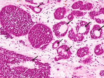 In the present two cases, the histopathological features, including nuclear pleomorphism, evidence of squamous differentiation and frequent mitotic figures, and the immunohistochemical
