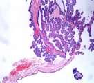 thyroglossal remnant
