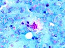 Objectives Generate a cytologic differential diagnosis for various cystic and solid head and neck lesions.