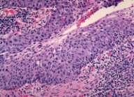 Biopsy Squamous cell