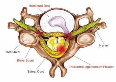 Cervical Disc Injuries C 5-6 segmental level was found to be the most common level of disc injury.