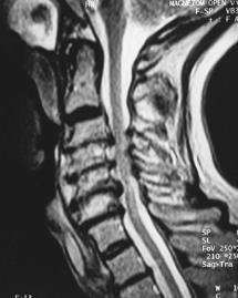 Spinal canal narrowing during simulated whiplash. Spine. 2004;29:1330-1339.