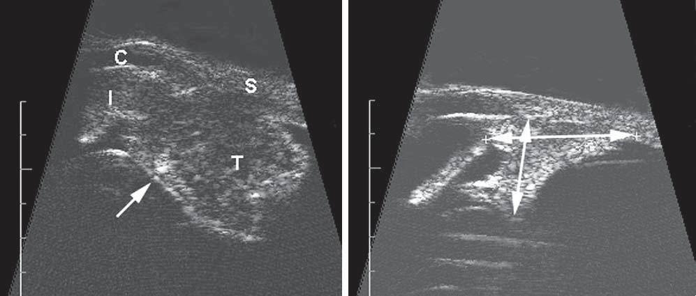 A I C T S Figure 1. Two 20-MHz high-frequency (longitudinal) ultrasonograms. A, An iridociliary melanoma (arrow) before plaque brachytherapy (C indicates cornea; I, iris; S, sclera; and T, tumor).