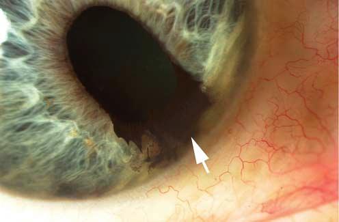 A Figure 2. Iris melanoma. A, Slitlamp photography showing corectopia, ectropion uvea (arrow), and intrinsic vascularity.