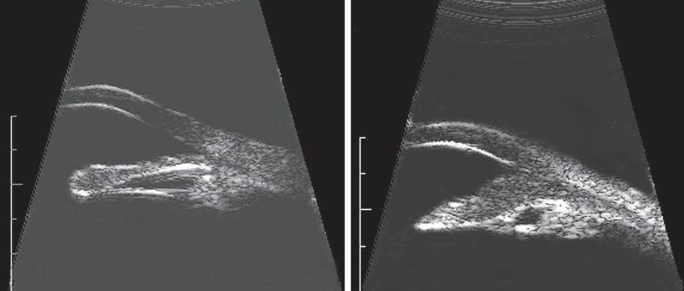 A Figure 4. Two high-frequency (20-MHz) longitudinal ultrasonograms. A, A club-shaped moderately reflective iris tumor with thinning of the iris pigment epithelium.