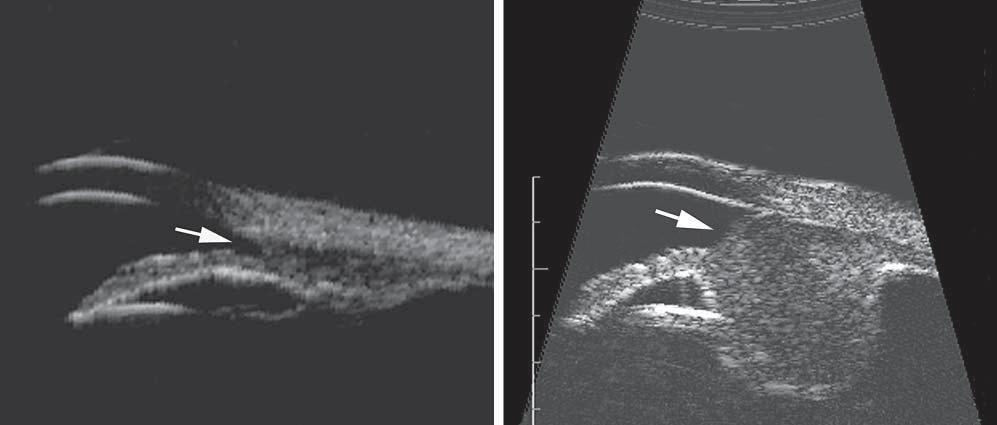 Iris disinsertion on high-frequency ultrasound images. A, A longitudinal 35-MHz section reveals a small amount of tumor-associated disinsertion of the iris root (arrow).