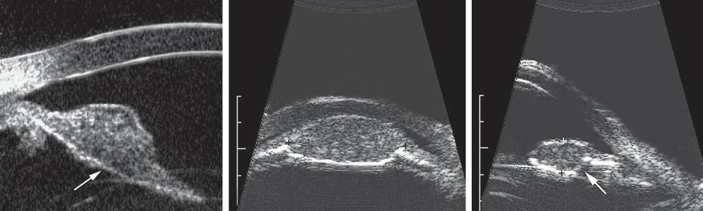 High-frequency ultrasound images of 3 iris melanomas that have disturbed the iris pigment epithelium (IPE).