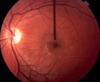 Ultrasound biomicroscopy: role in diagnosis and management in 130 consecutive patients evaluated for anterior segment tumours. r J Ophthalmol. 2005;89(8):950-955. 16.