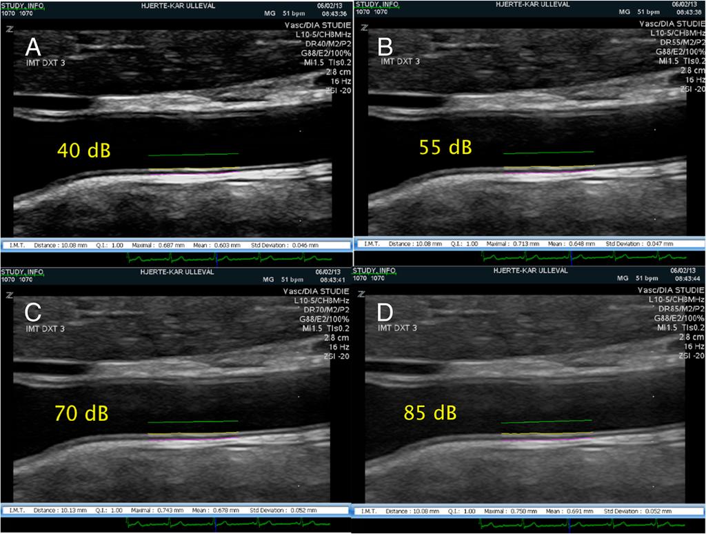 Gaarder and Seierstad Cardiovascular Ultrasound 2015, 13:5 Page 3 of 5 Figure 2 CIMT measurements of the same CCA for different DRs.