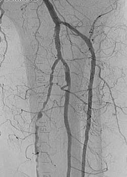 Diagnostic Angiogram IVL