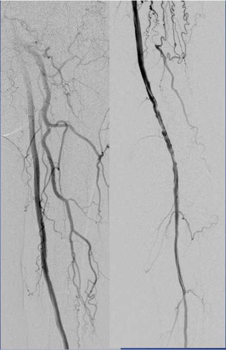 how to do this When are Stent-Grafts the Preferred Treatment for Long FPA