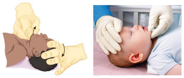 Opening the Airway Head-Tilt, Chin-Lift in Infants and Children Place in neutral