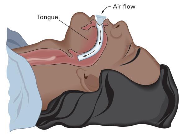 ventilation Airway Adjuncts Oropharyngeal (Oral) Airway Holds the