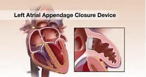 6. Left Atrial Appendage Closure Devices