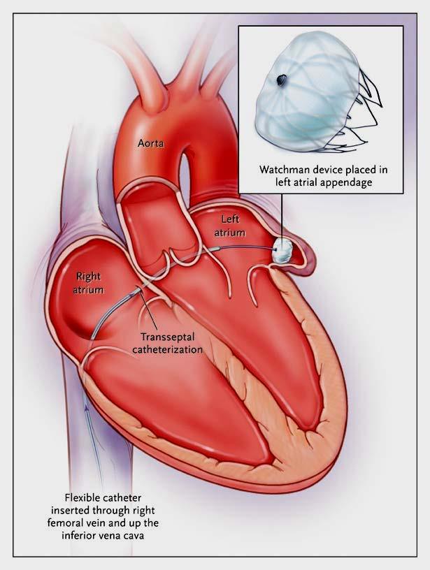 The Watchman Left Atrial Appendage
