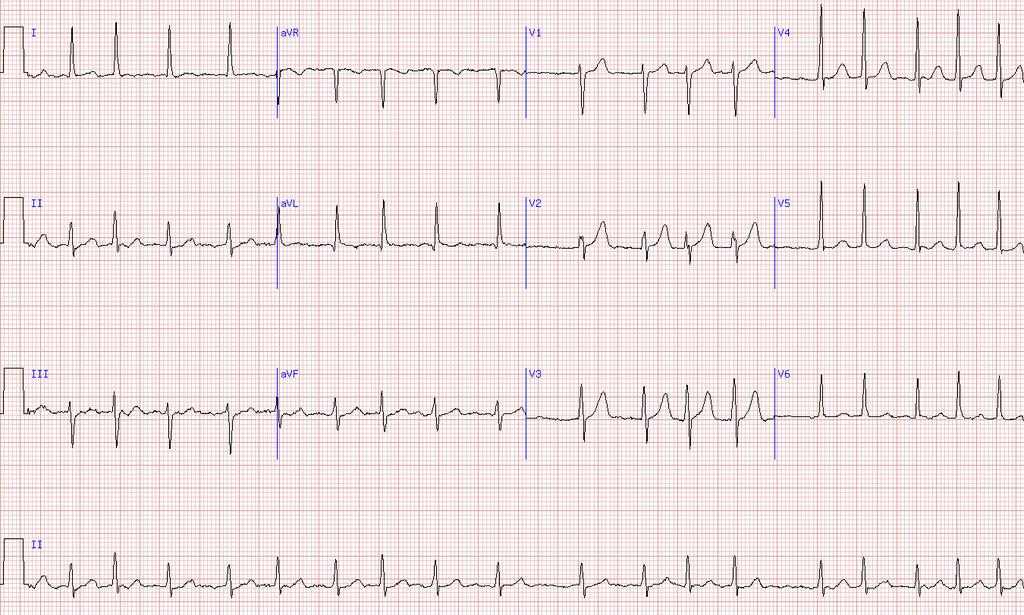 Case #3: 57M with Lone Paroxsymal AF Severe palpitations 1-3x/month, up to 45