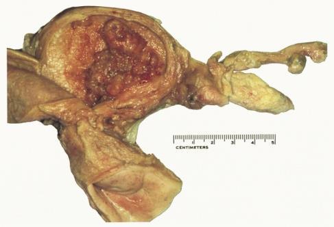 Clinical features of Endometrial Adenocarcinoma: Most patients are between 50 and 60 years. Many of the patients tend to be nulliparous and obese.