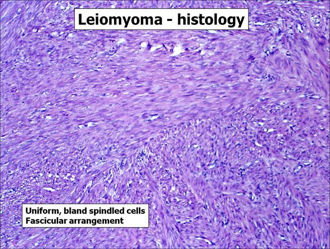 Mitotic figures are scarce. No necrosis, No atypia, No mitosis. If there is, then it s leiomyosarcoma.