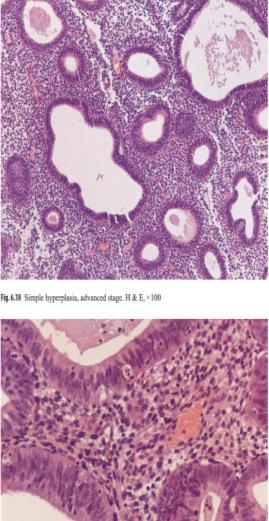see atypia Simple hyperplasia (cystic hyperplasia): glands are variably shaped and sized and cystically dilated with