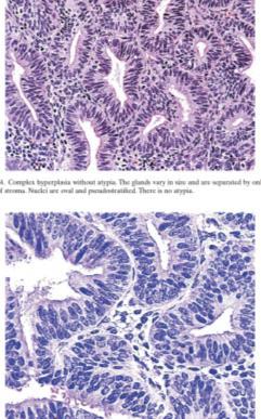 Proliferation of endometrial glands resulting in complex crowded glands with papillary infoldings and irregular shapes.