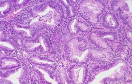 The epithelial cells remain cytologically normal. 3% progression to carcinoma.