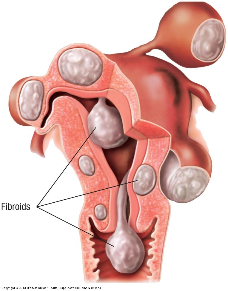 Disorders of the Uterus" Fibroid tumors Benign growths in the muscles or connective tissue of the uterus.