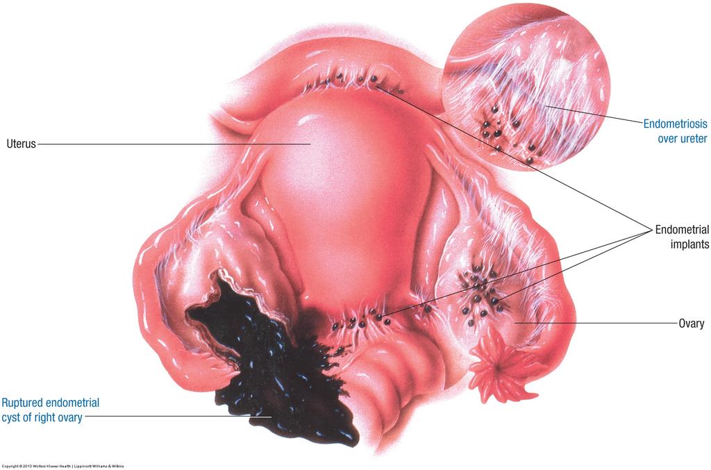 Disorders of the Uterus" Endometriosis Implantation and growth of endometrial cells in the peritoneal cavity.