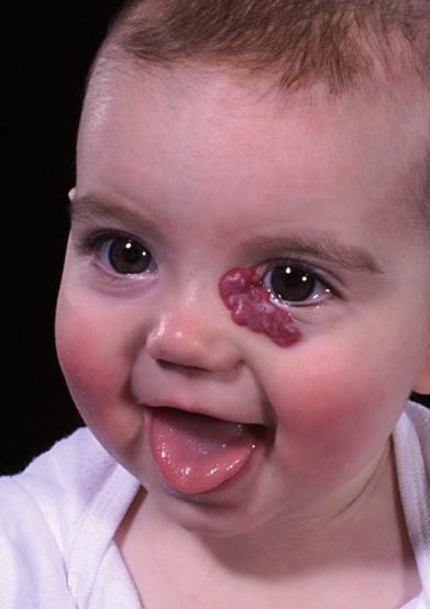 Haemangiomas Information for families Great