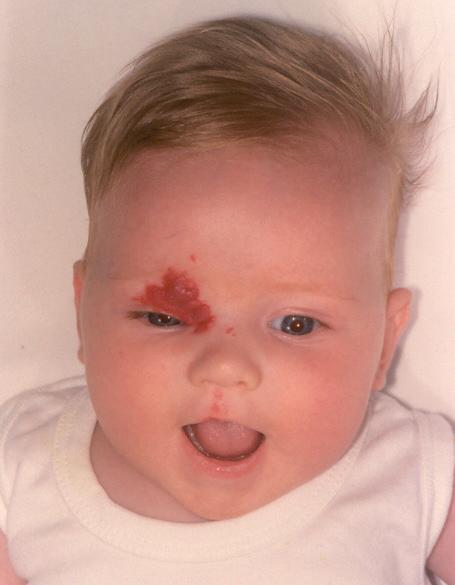 If the haemangioma gets in the way of a child s field of vision, a condition called lazy eye (amblyopia) can develop because the brain will filter out the image